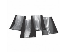 Four Fractures X-Rays