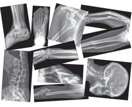 Broken Bone X-Ray